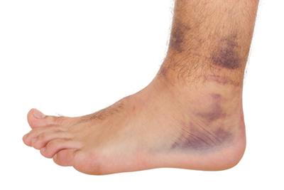 Sprained ankle image